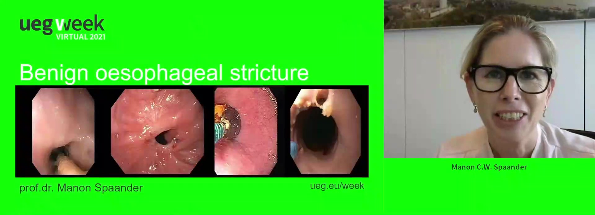 Benign oesophageal stricture